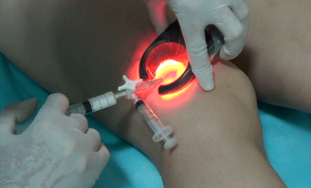 Skleroterapia to skuteczna metoda leczenia żylaków nóg